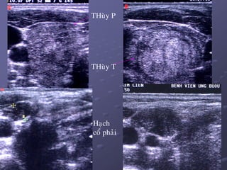 45
THuøy P
THuøy T
Haïch
coå phaûi
 