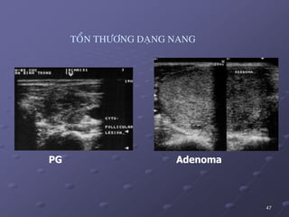 47
TOÅN THÖÔNG DAÏNG NANG
PG Adenoma
 