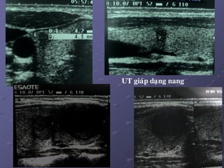 48
UT giaùp daïng nang
 