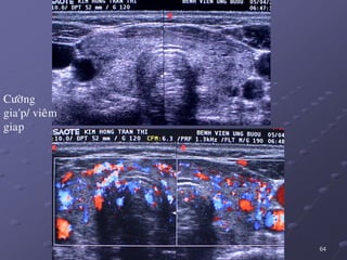 64
Cöôøng
gia'p/ vieâm
giap
 