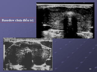 69
Basedow chöa ñieàu trò
 