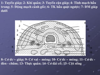 7
1
2
3
4
8
9
10
11
12
13
14
15
5
6
7
1- Tuyeán giaùp; 2- Khí quaûn; 3- Tuyeán caän giaùp; 4- Tónh maïch haàu
trong; 5- Ñoäng maïch caûnh goác; 6- TK haàu quaët ngöôïc; 7- ÑM giaùp
döôùi
8- Cô öùc – giaùp; 9- Cô vai – moùng; 10- Cô öùc – moùng; 11- Cô öùc -
ñoøn - chuõm; 13- Thöïc quaûn; 14- Cô daøi coå; 15- Coät soáng
 