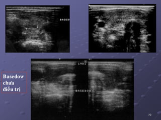 70
Basedow
chöa
ñieàu trò
 
