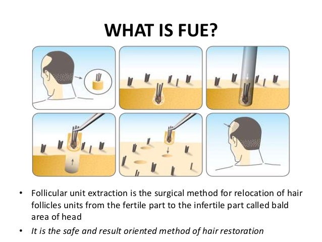 Satyam Follicular Unit Extraction Procedure