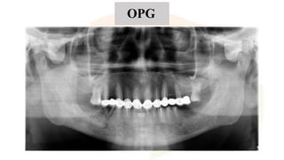 SATYANARAYANA MURTHY implant placement using surgical guide | PPTX