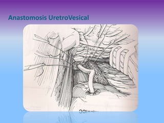 Anastomosis UretroVesical

 