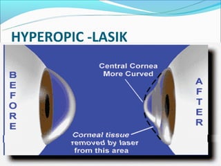 HYPEROPIC -LASIK
 