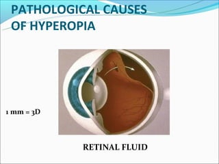 PATHOLOGICAL CAUSES
 OF HYPEROPIA




1 mm = 3D



            RETINAL FLUID
 