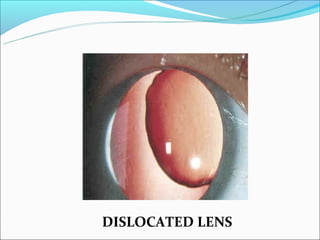 DISLOCATED LENS
 