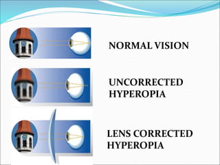NORMAL VISION
UNCORRECTED
HYPEROPIA
LENS CORRECTED
HYPEROPIA
 