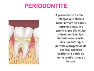 PERIODONTITE A periodontite é uma infecção que ataca o osso.Formam-se bolsas entre os dentes e a gengiva, que são muito difíceis de higienizar durante a escovação. Isso é um fator que permite a progressão da doença, podendo ocasionar a perda do dente se não tratada a tempo. 