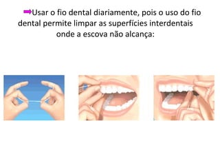 Usar o fio dental diariamente, pois o uso do fio dental permite limpar as superfícies interdentais onde a escova não alcança: 
