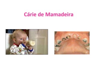 Cárie de Mamadeira 