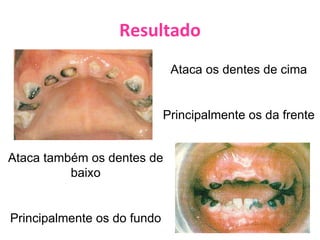 Resultado Ataca os dentes de cima Principalmente os da frente Ataca também os dentes de baixo Principalmente os do fundo 