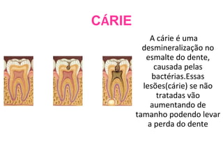 C Á RIE A cárie é uma desmineralização no esmalte do dente, causada pelas bactérias.Essas lesões(cárie) se não tratadas vão aumentando de tamanho podendo levar a perda do dente 