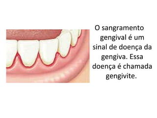 .  O sangramento gengival é um sinal de doença da gengiva. Essa doença é chamada gengivite.  