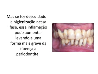 Mas se for descuidado a higienização nessa fase, essa inflamação pode aumentar levando a uma forma mais grave da doença a periodontite  