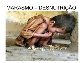 MARASMO – DESNUTRIÇÃO  Silmara Robles Escorsin 