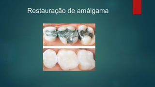 Restauração de amálgama
 