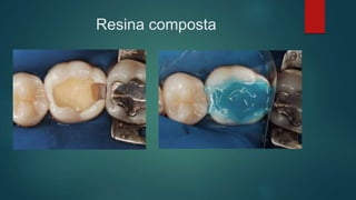 Resina composta
 