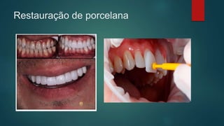 Restauração de porcelana
 
