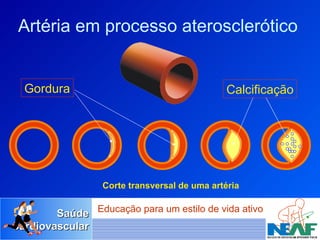 Artéria em processo aterosclerótico Corte transversal de uma artéria Gordura Calcificação 