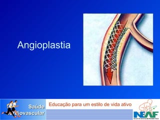 Angioplastia 