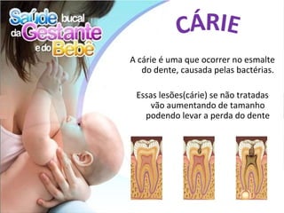 A cárie é uma que ocorrer no esmalte
   do dente, causada pelas bactérias.

 Essas lesões(cárie) se não tratadas
     vão aumentando de tamanho
   podendo levar a perda do dente
 