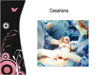 Cesariana
 