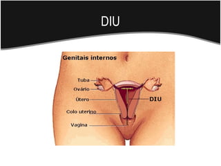 DIU
 