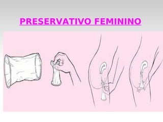 PRESERVATIVO FEMININO
 