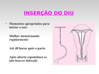 INSERÇÃO DO DIU

    Momentos apropriados para
    iniciar o uso:

-   Mulher menstruando
    regularmente

-   Até 48 horas após o parto

-   Após aborto espontâneo se
    não houver infecção
 