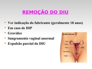 REMOÇÃO DO DIU


    Ver indicação do fabricante (geralmente 10 anos)

    Em caso de DIP

    Gravidez

    Sangramento vaginal anormal

    Expulsão parcial do DIU
 