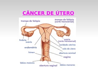 CÂNCER DE ÚTERO
 