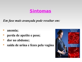 Sintomas

Em fase mais avançada pode resultar em:


    anemia;

    perda de apetite e peso;

    dor no abdome;

    saída de urina e fezes pela vagina
 