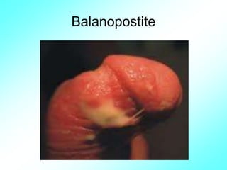 Balanopostite
 