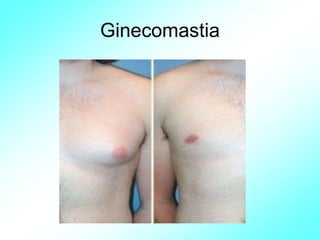 Ginecomastia
 
