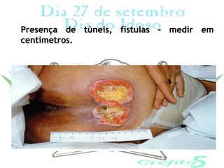 Presença de túneis, fístulas – medir em
centímetros.
 