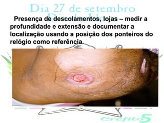 Presença de descolamentos, lojas – medir a
profundidade e extensão e documentar a
localização usando a posição dos ponteiros do
relógio como referência.
 