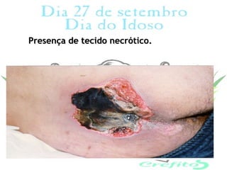 Presença de tecido necrótico.
 