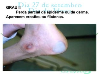 GRAU II
     Perda parcial da epiderme ou da derme.
Aparecem erosões ou flictenas.
 