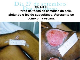 GRAU III
       Perda de todas as camadas da pele,
afetando o tecido subcutâneo. Apresenta-se
             como uma escara.
 
