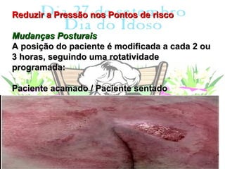 Reduzir a Pressão nos Pontos de risco

Mudanças Posturais
A posição do paciente é modificada a cada 2 ou
3 horas, seguindo uma rotatividade
programada:

Paciente acamado / Paciente sentado
 