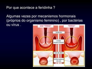 Por que acontece a feridinha ?

Algumas vezes por mecanismos hormonais
(próprios do organismo feminino) , por bactérias
ou vírus .
 