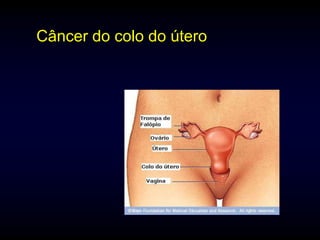 Câncer do colo do útero
 