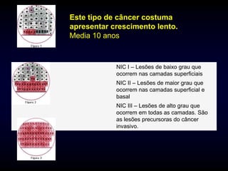 Este tipo de câncer costuma
apresentar crescimento lento.
Media 10 anos



            NIC I – Lesões de baixo grau que
            ocorrem nas camadas superficiais
            NIC II – Lesões de maior grau que
            ocorrem nas camadas superficial e
            basal
            NIC III – Lesões de alto grau que
            ocorrem em todas as camadas. São
            as lesões precursoras do câncer
            invasivo.
 