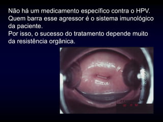 Não há um medicamento específico contra o HPV.
Quem barra esse agressor é o sistema imunológico
da paciente.
Por isso, o sucesso do tratamento depende muito
da resistência orgânica.
 