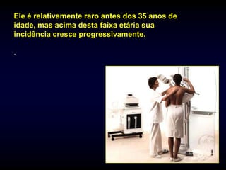 Ele é relativamente raro antes dos 35 anos de
idade, mas acima desta faixa etária sua
incidência cresce progressivamente.

.
 
