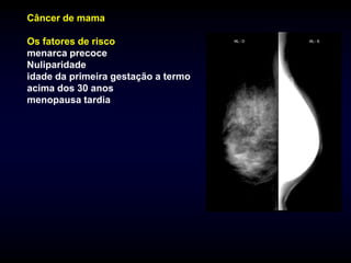 Câncer de mama

Os fatores de risco
menarca precoce
Nuliparidade
idade da primeira gestação a termo
acima dos 30 anos
menopausa tardia
 