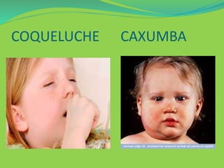 COQUELUCHE CAXUMBA 
 